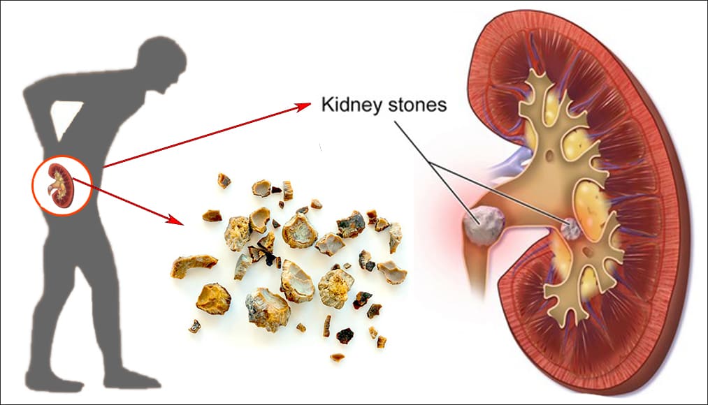 kidney-stone