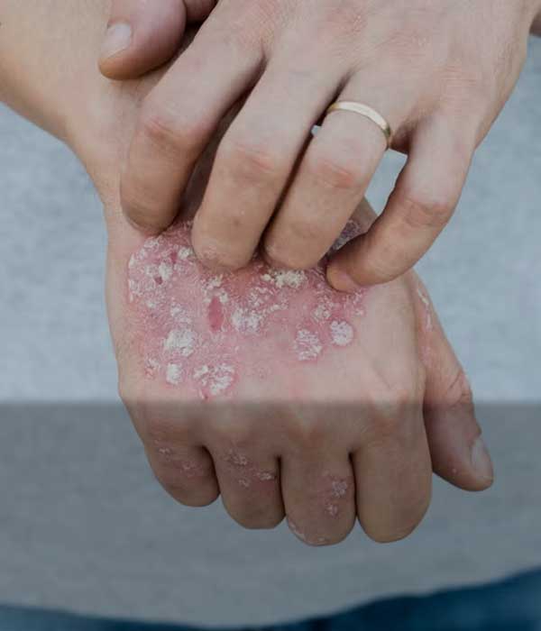 Psoriasis