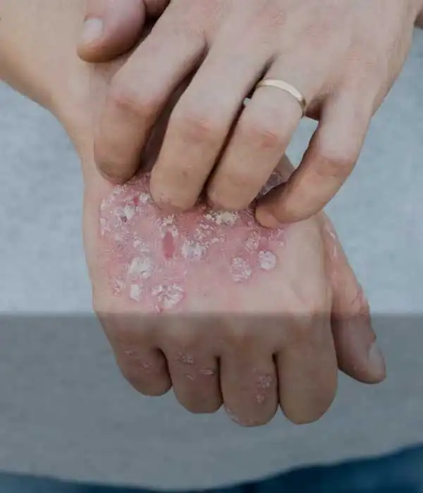 Psoriasis