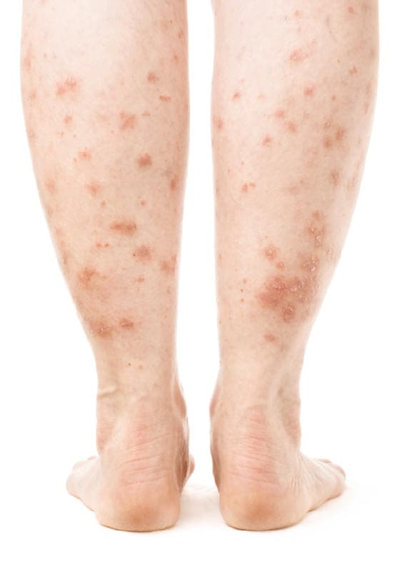 psoriasis